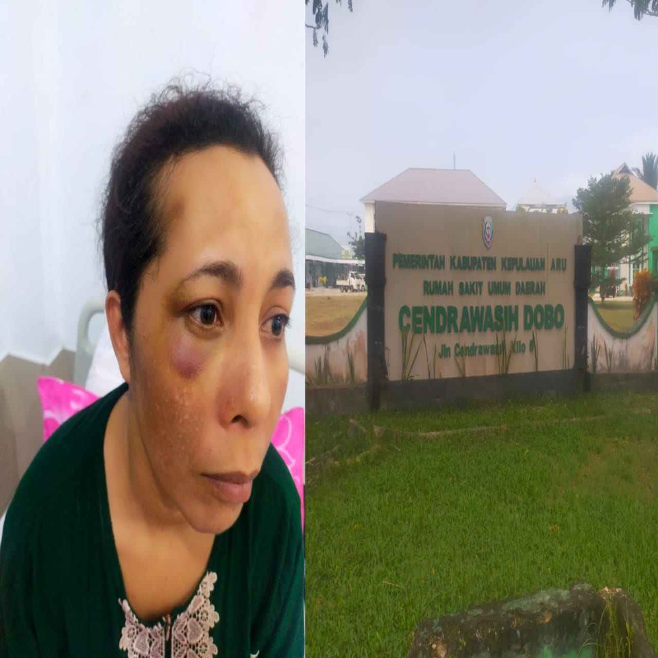 Tahanan Perempuan.MG yang diduga dianiya oknum Pegawai Lapas Kabupaten Kepulauan Aru